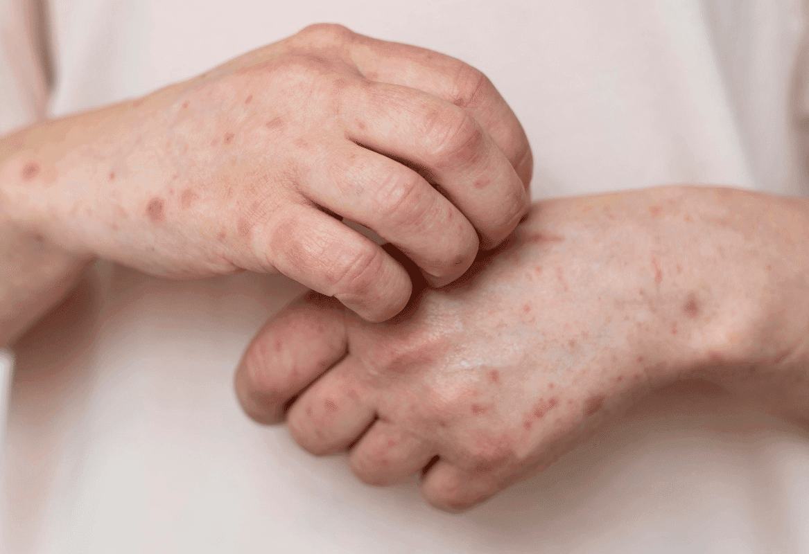 Brasil já registra 88 casos de Mpox em 2026